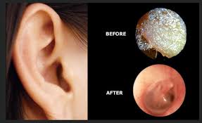 ear wax clinic