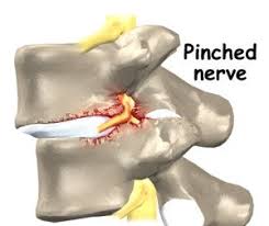 pinched nerve
