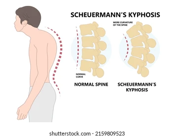 scheuermann's disease
